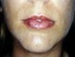 Juvederm Before