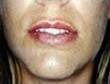 Juvederm After